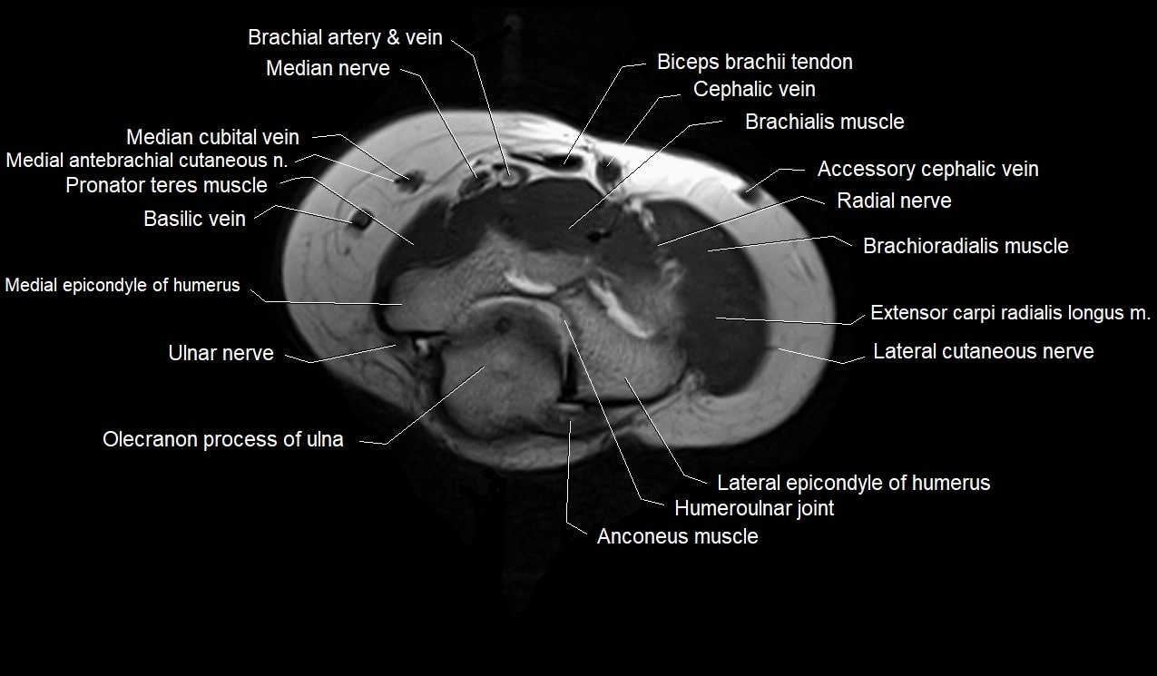 MRI 3T forearm axial cross sectional anatomy image 3.webp